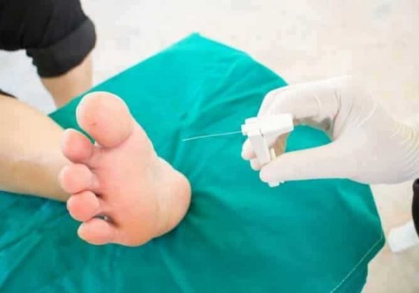 מהי נוירופתיה סוכרתית